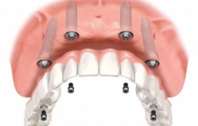 Những ưu điểm của phương pháp cấy ghép răng implant all-in-4 