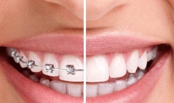 Các bước niềng răng để có một hàm răng đẹp 